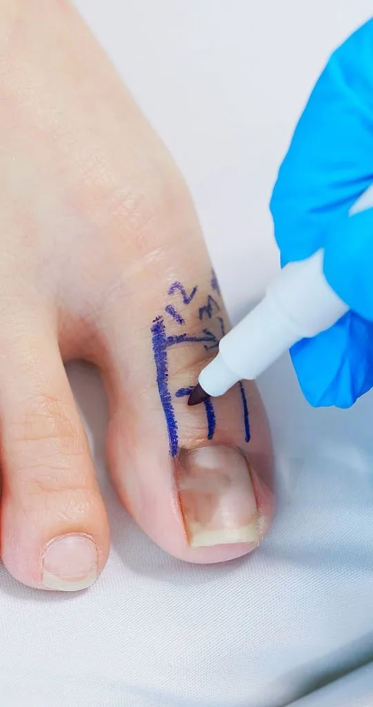 Ingrown Toenail Surgery