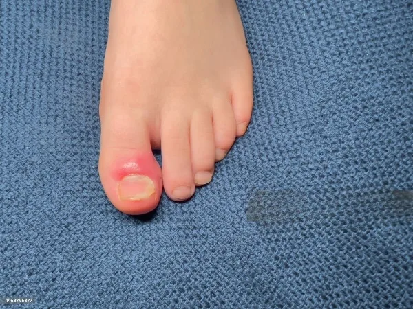 Ingrown Toenail Surgery