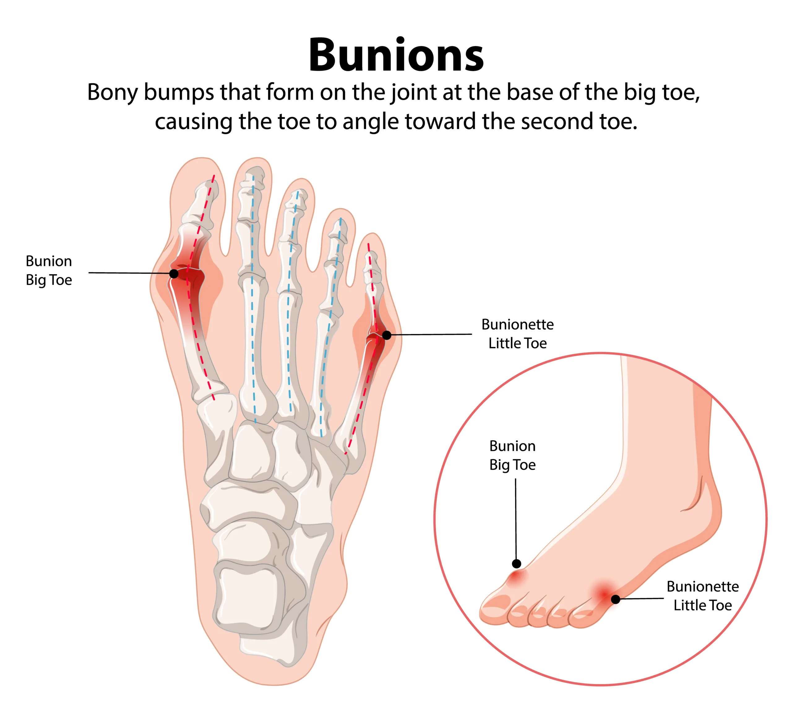Diagram showing bunions on foot bones