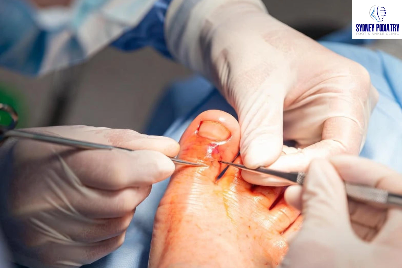 Ingrown Toenail Nail Surgery