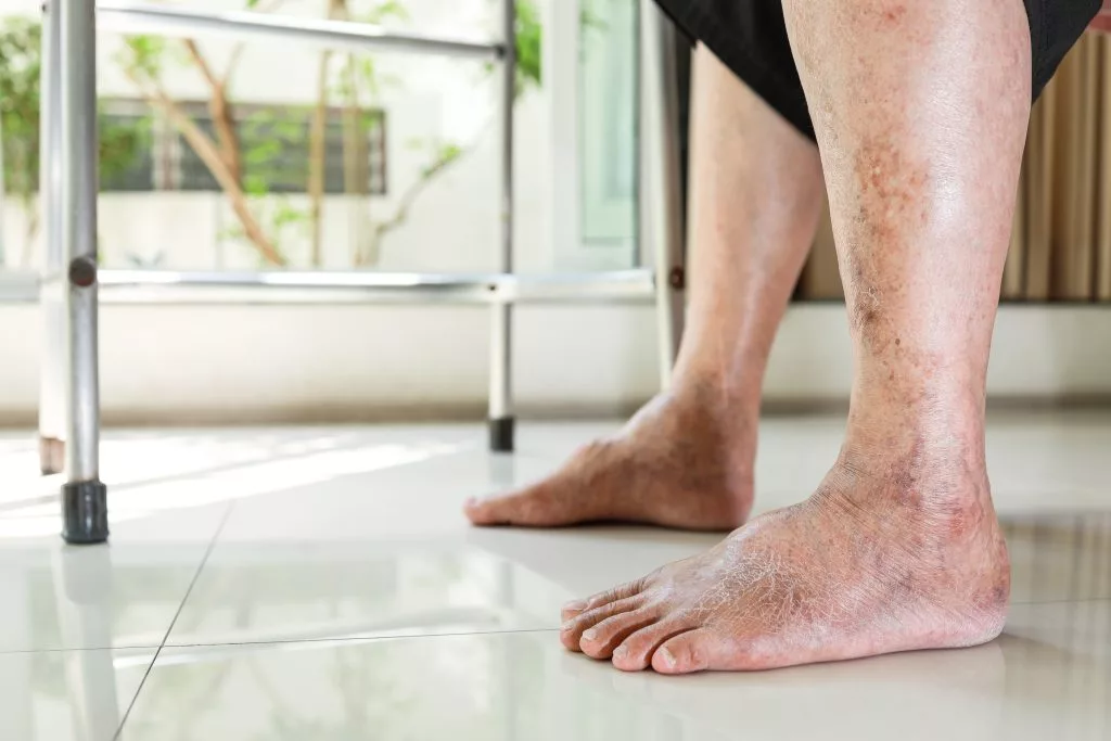 diabetic foot care