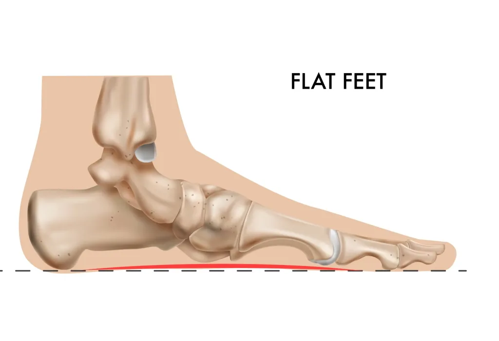 flat-feet