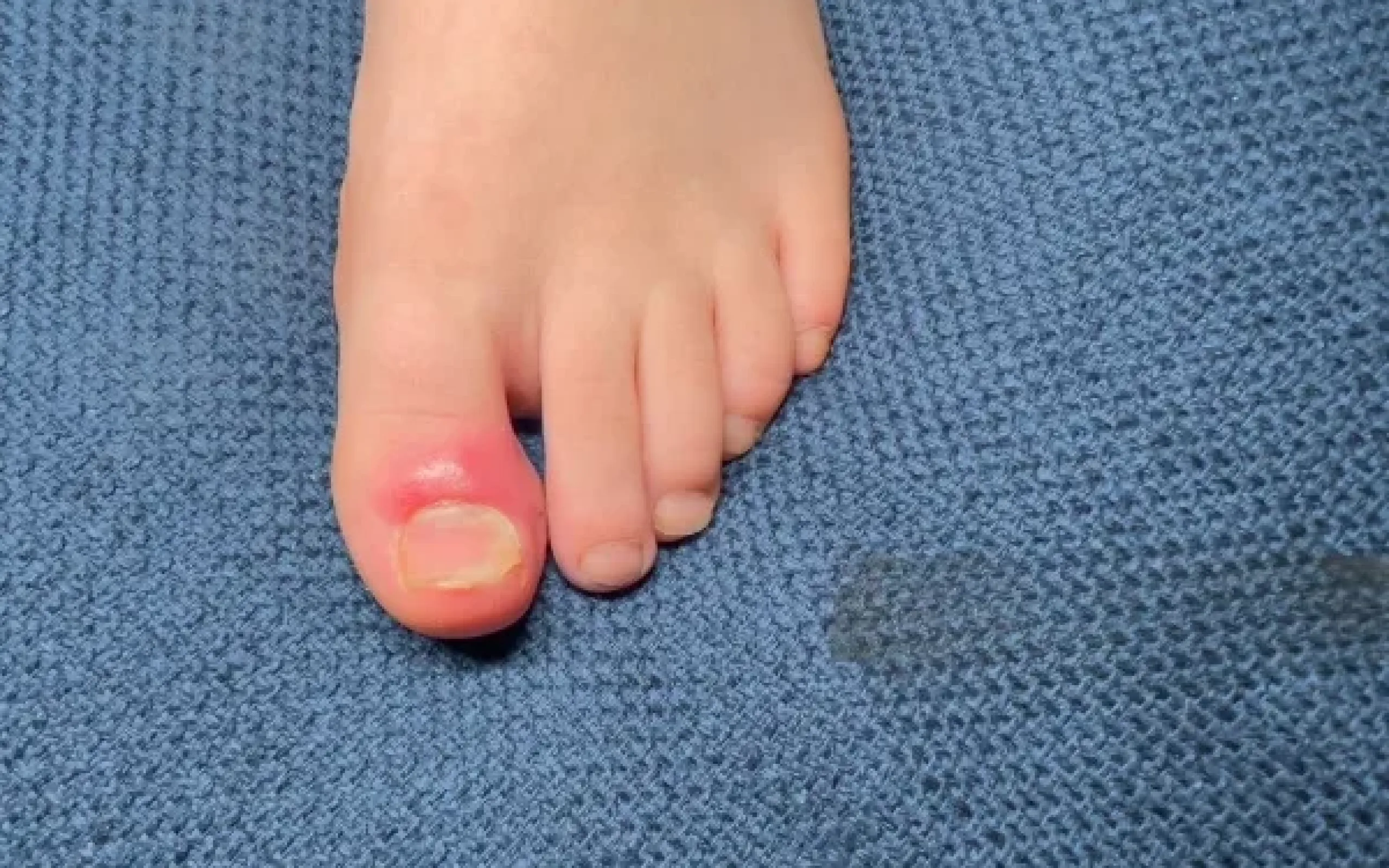 Ingrown Toenail Surgery
